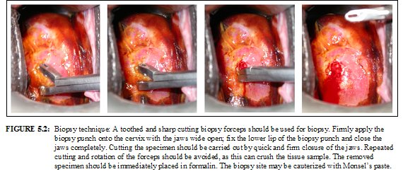 Colposcopy and treatment of cervical intraepithelial neoplasia: a
