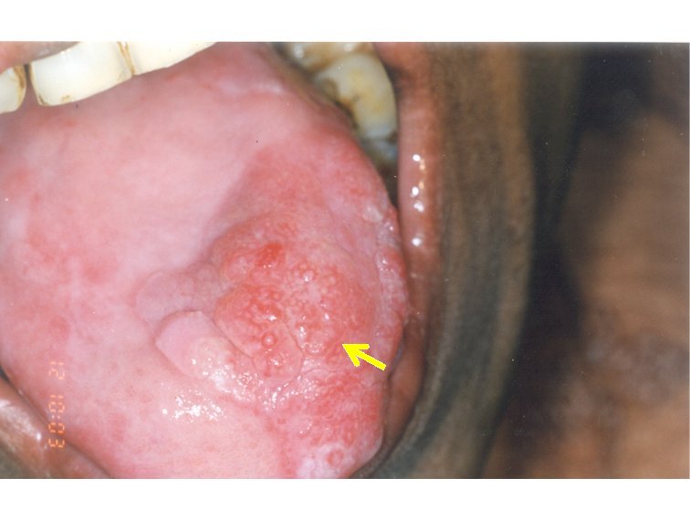 oral submucous fibrosis #11