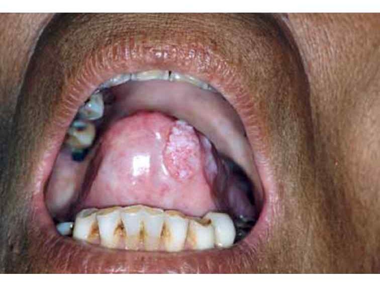 Oral Submucous Fibrosis - Very Worried Please Help! - ABC ...
