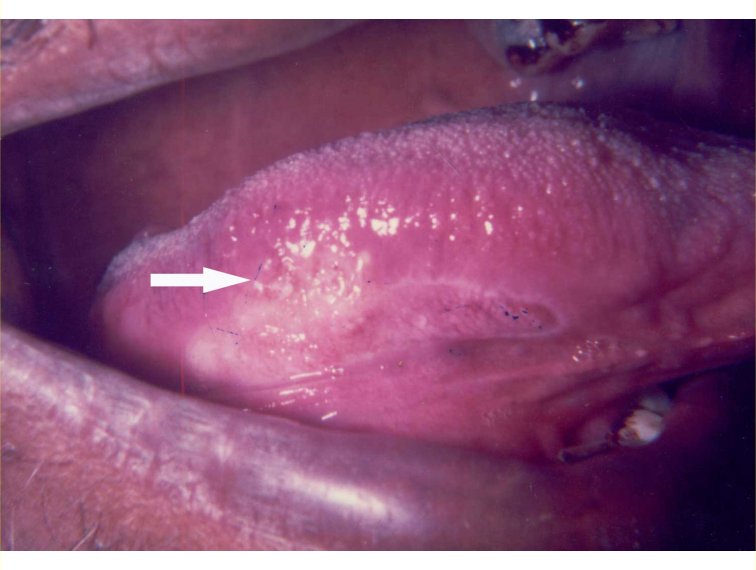 Tongue Lichen Planus