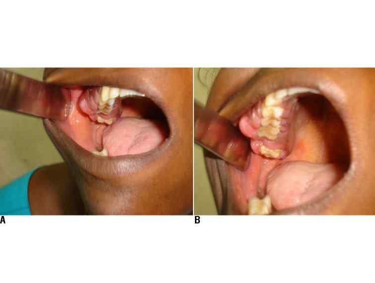 Cavities In Molars. of the oral cavity.