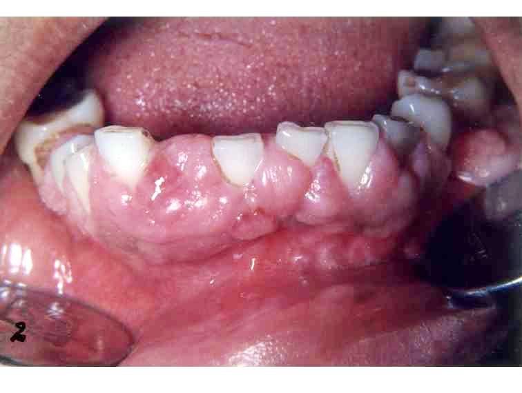 Gingival Hypoplasia