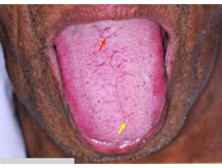 tongue fissures