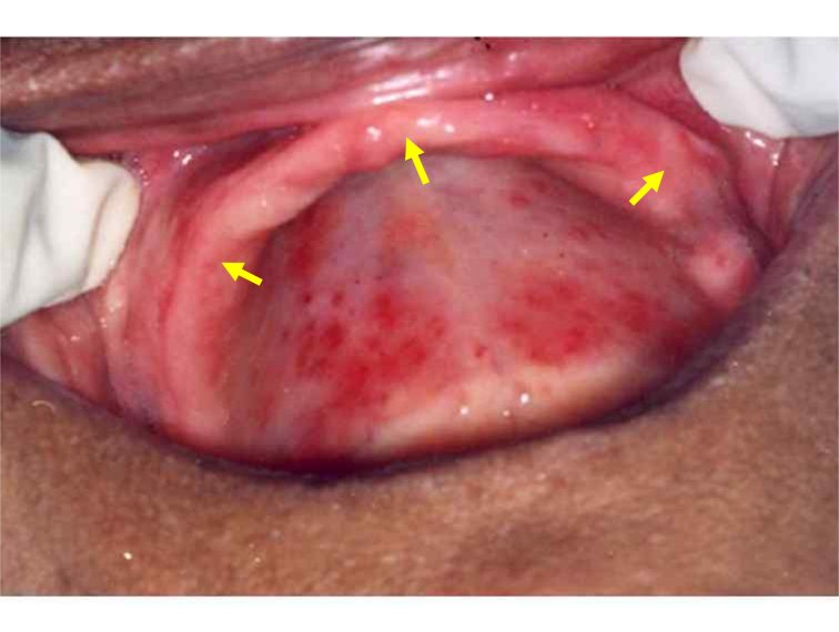 Ill-Fitting Dentures in Falmouth