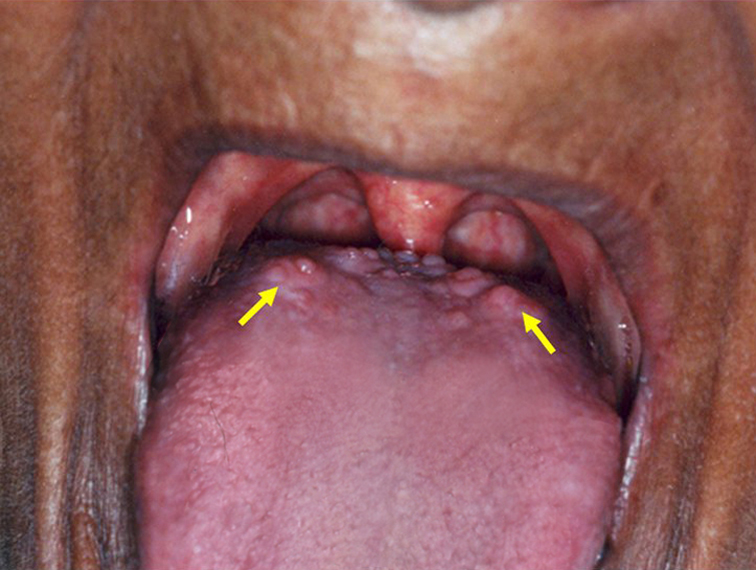 Cat Tongue Papillae