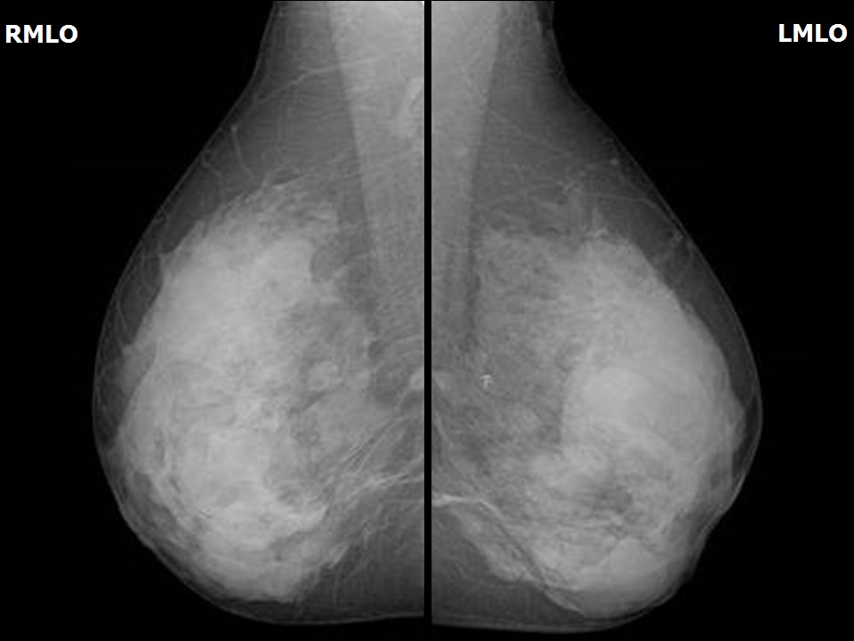 Basic anatomy & Radiology for breast cancer case