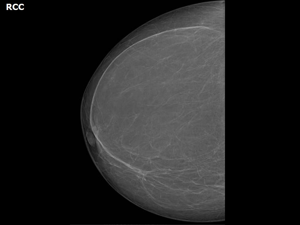 A 34-year old female patient presented by a left breast malignant mass
