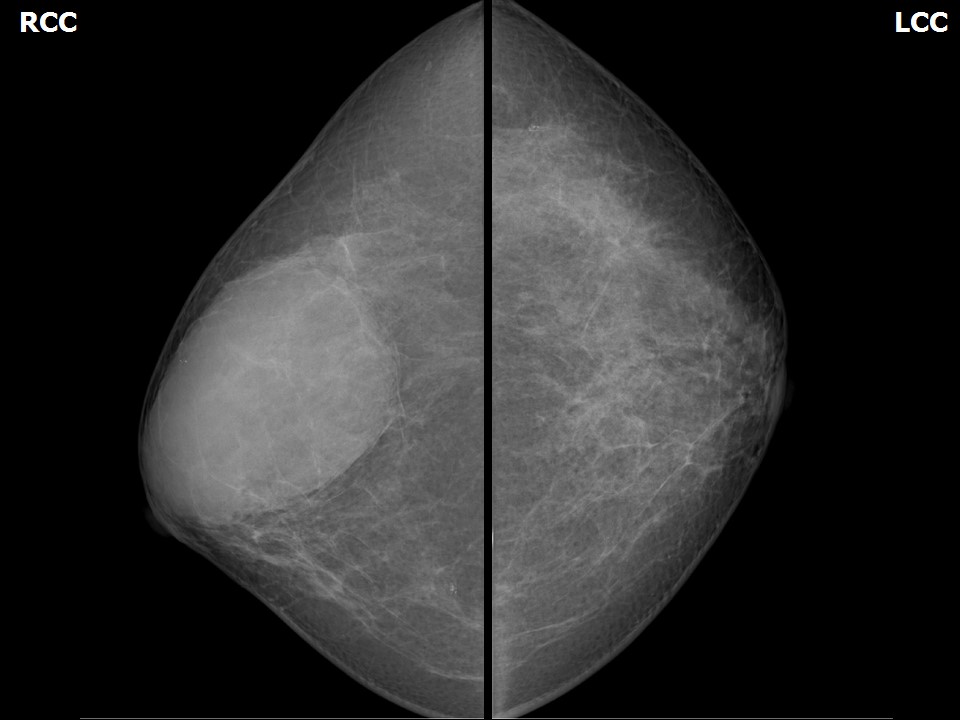 A 38-year old female patient presented by a left breast malignant mass