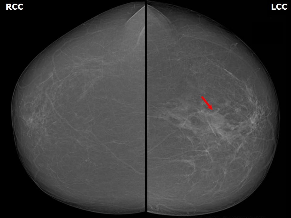 Atlas of breast cancer early detection