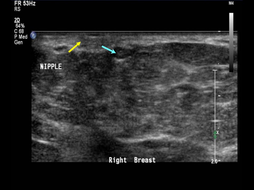 Findings of the right nipple; ultrasound and MR images of the breast. a