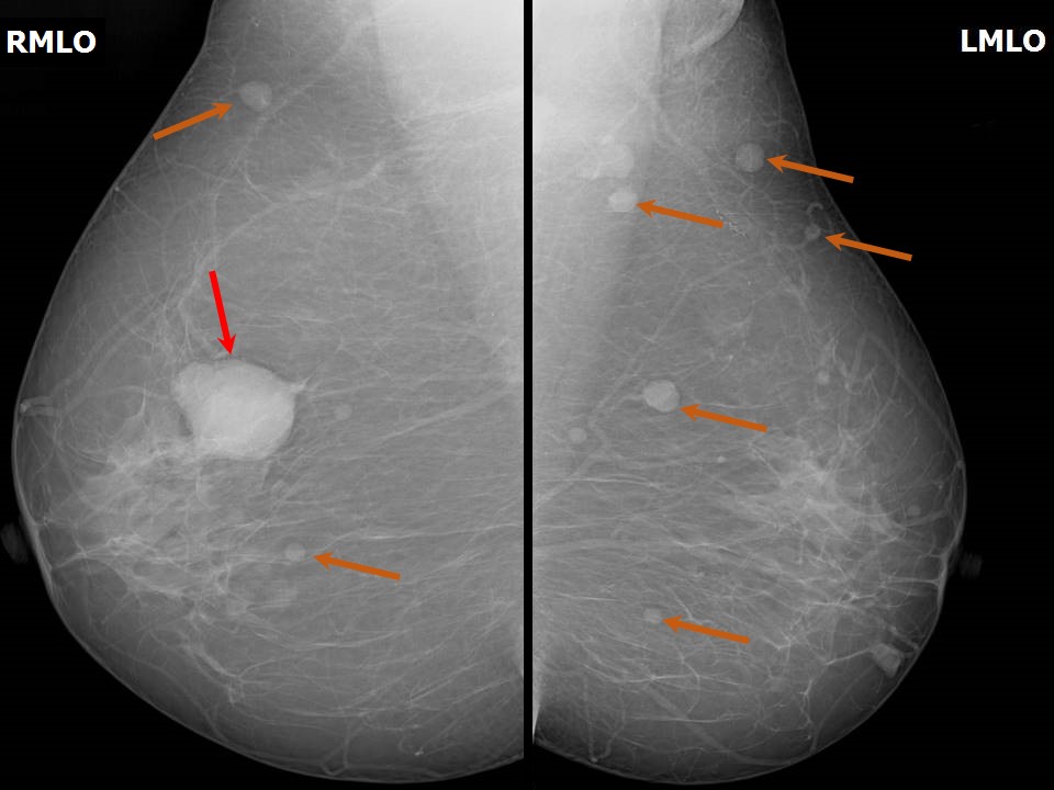 Subcutaneous Tissue (Superior Medial Quadrant of Breast; Left