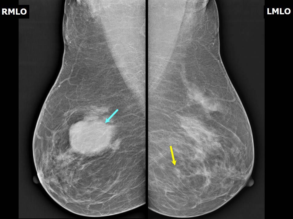 A‐D, Breast MRI, with bilateral multiple masses, two in the right