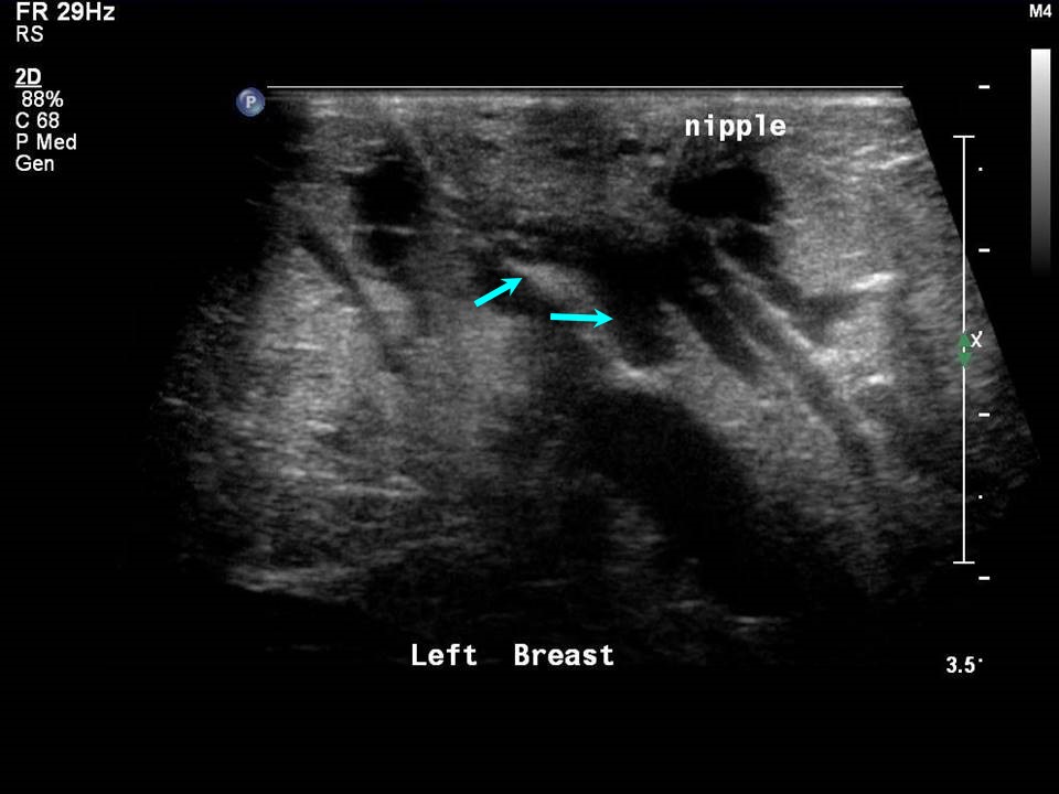Normal breast - composition B, Radiology Case