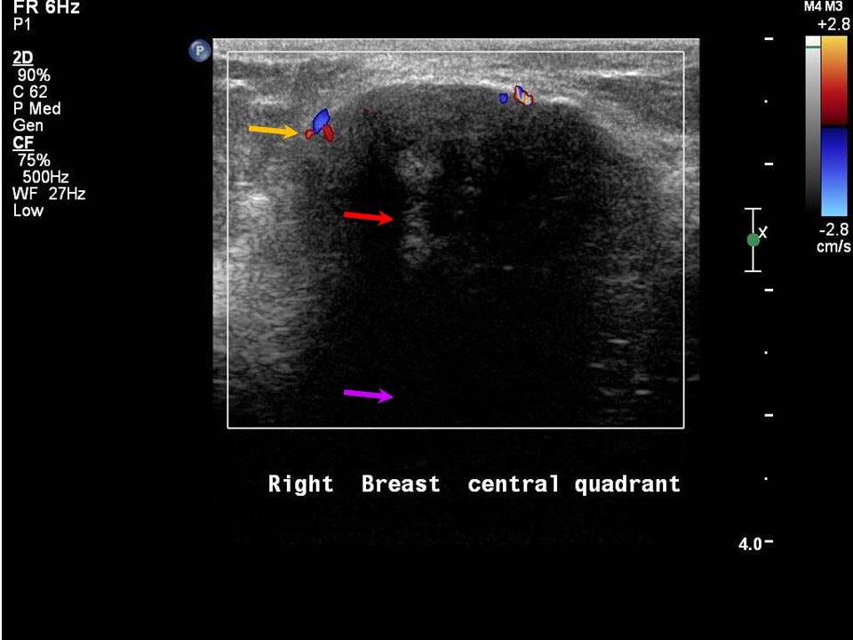 What Does Inflammatory Breast Cancer on Ultrasound Mean