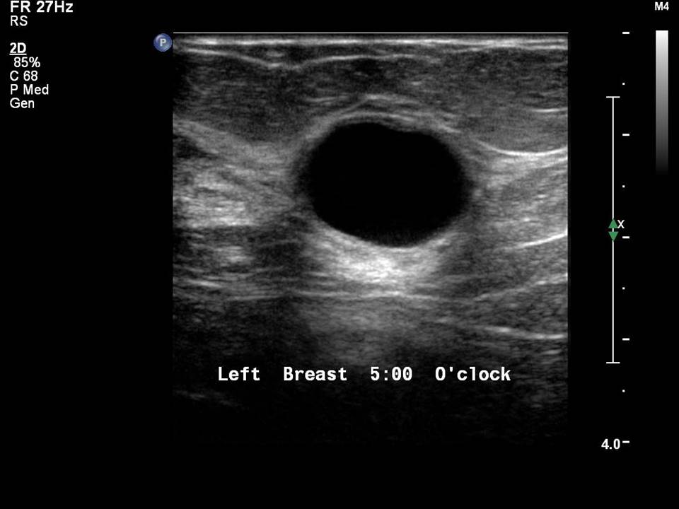 Benign Cyst On Areola