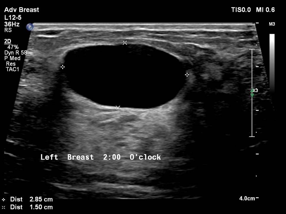 Atlas of breast cancer early detection