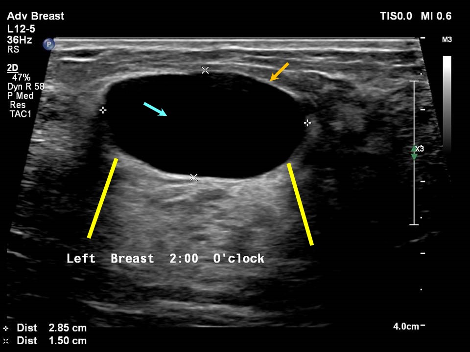 Enlarging Breast Cyst Factory Sale Centralcountiesservices