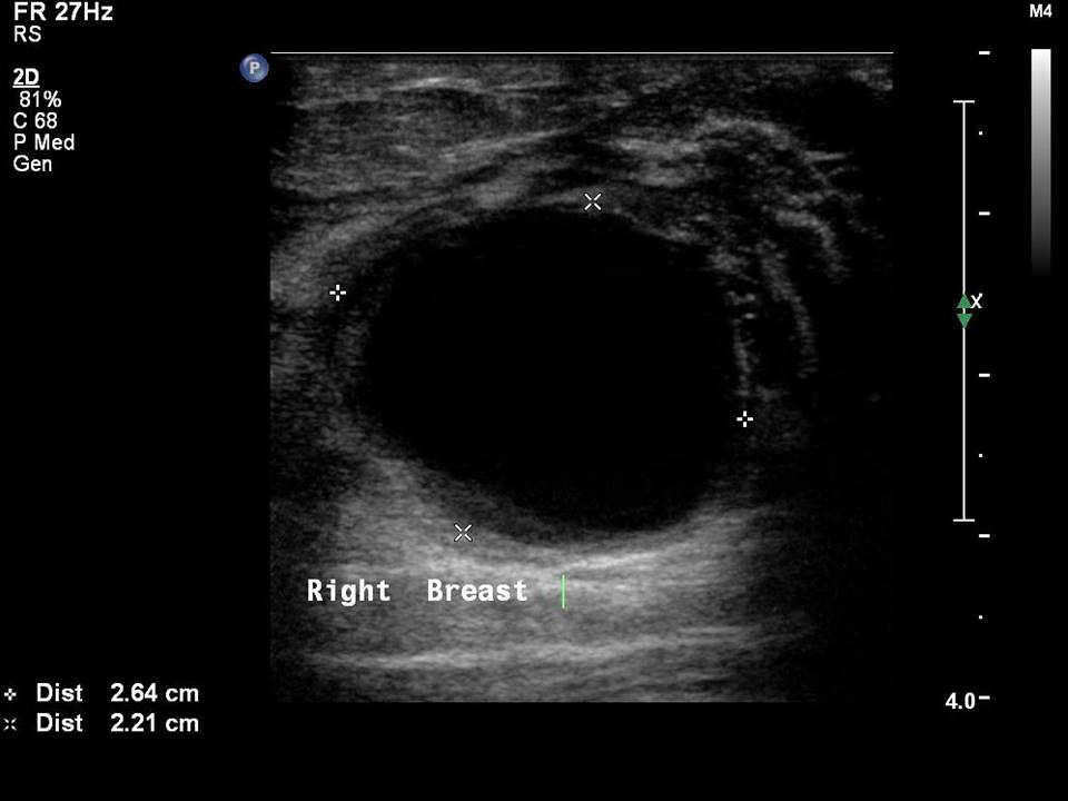 atlas-of-breast-cancer-early-detection