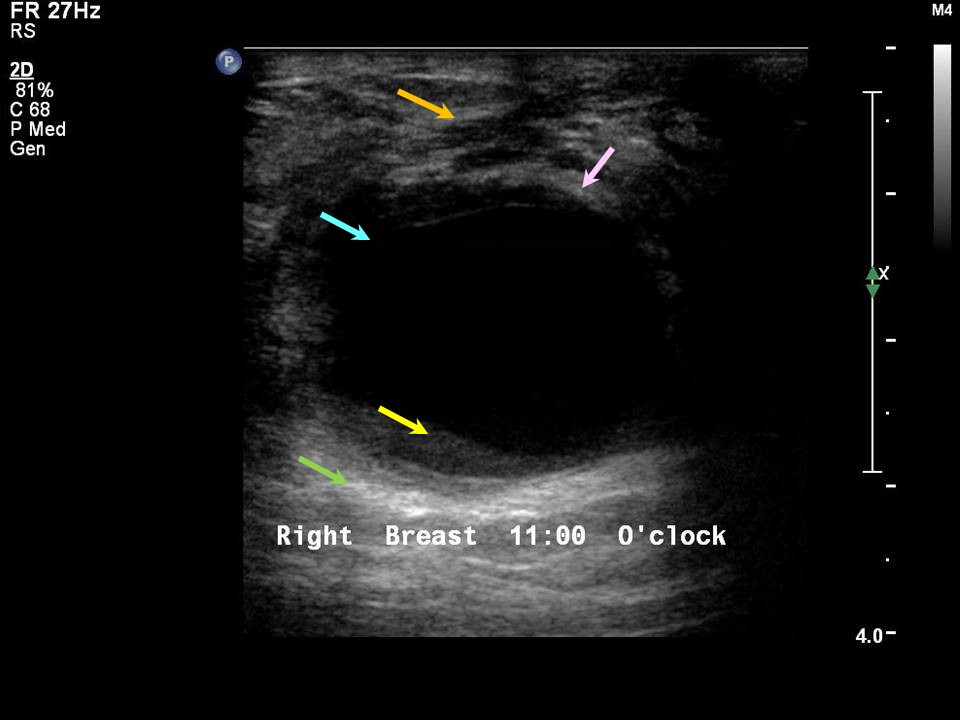 cystic-masses-of-the-breast-ajr