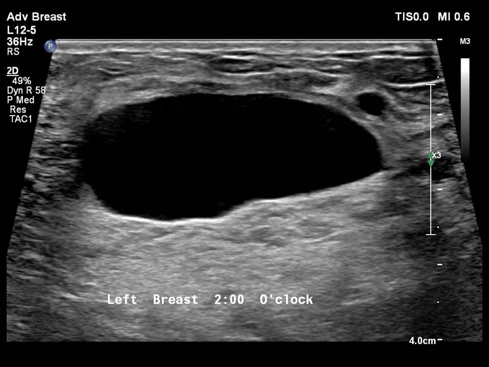 Atlas Of Breast Cancer Early Detection