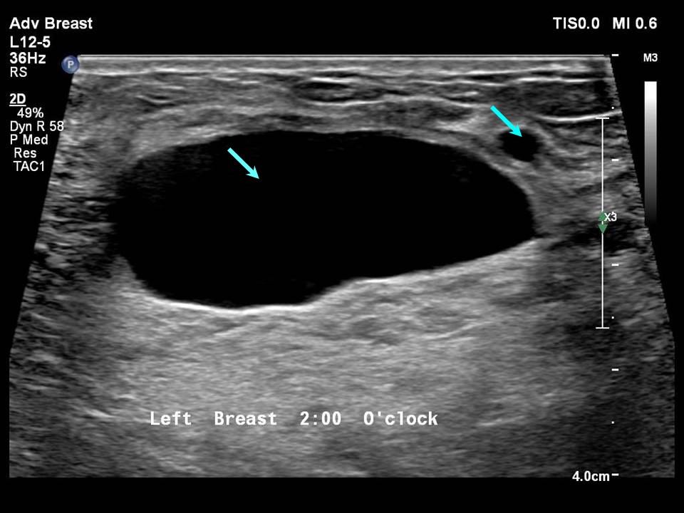 What Does Breast Cancer Look Like On An Mri With Contrast At Charles 