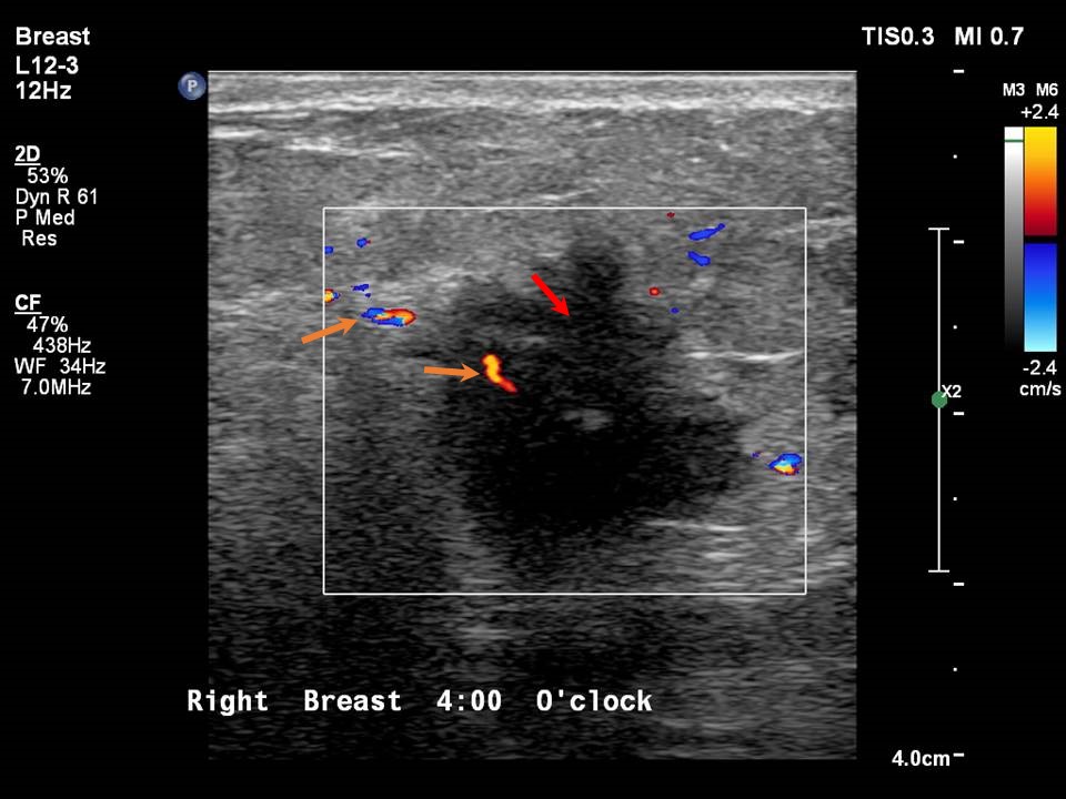 atlas-of-breast-cancer-early-detection