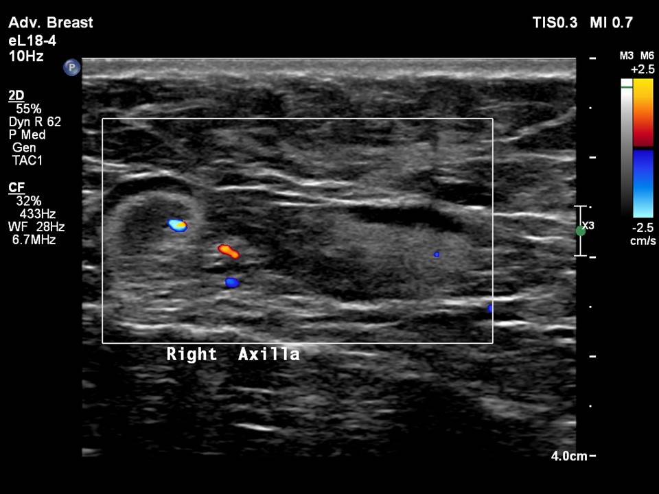 Atlas of breast cancer early detection