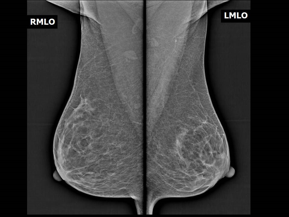 A) Bilateral medio-lateral mammograms revealed asymmetric breast