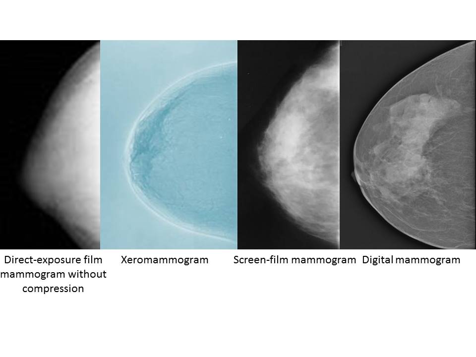 Atlas of breast cancer early detection