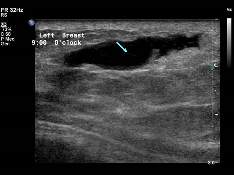 invasive ductal carcinoma ultrasound