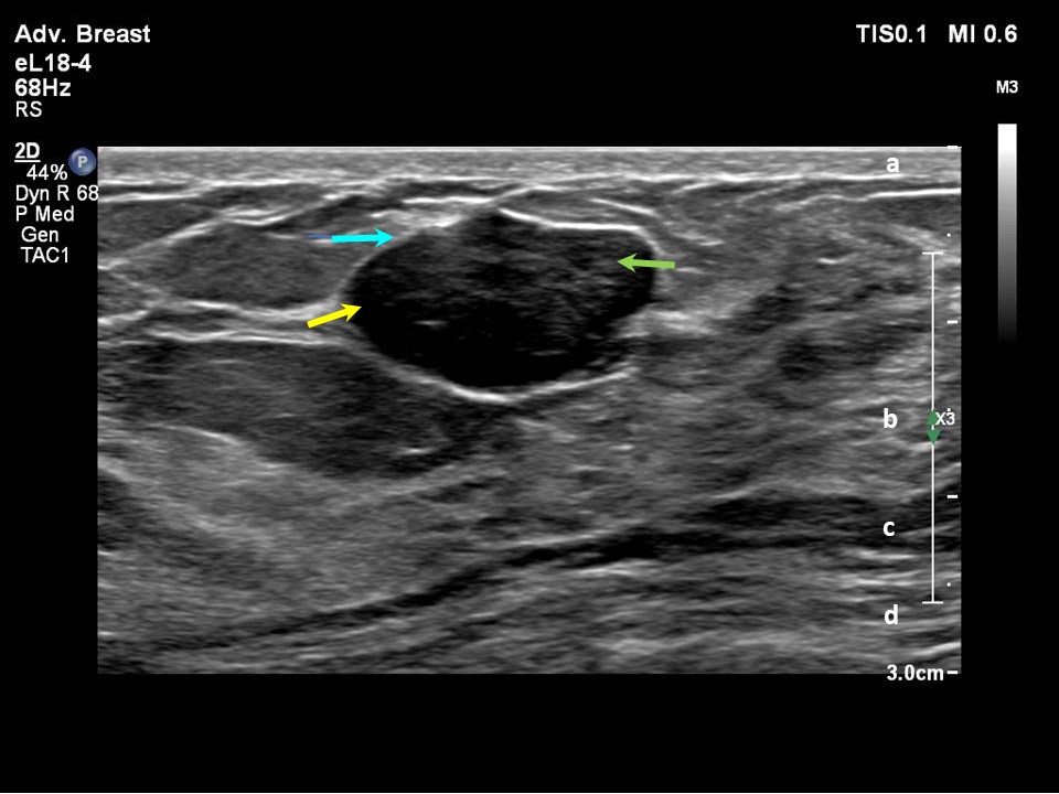 Anechoic Ultrasound