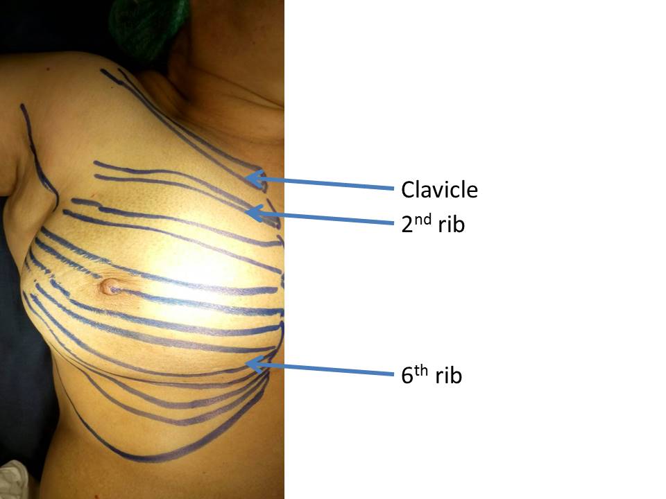 Subcutaneous Tissue (Superior Medial Quadrant of Breast; Left