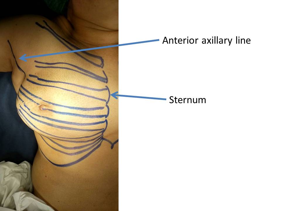 Illustration Of Female Human Breast, Outline And Breast Cancer