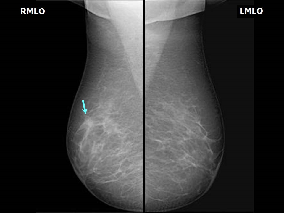 Breast Asymmetry and Calcification: Causes, Symptoms, Treatment