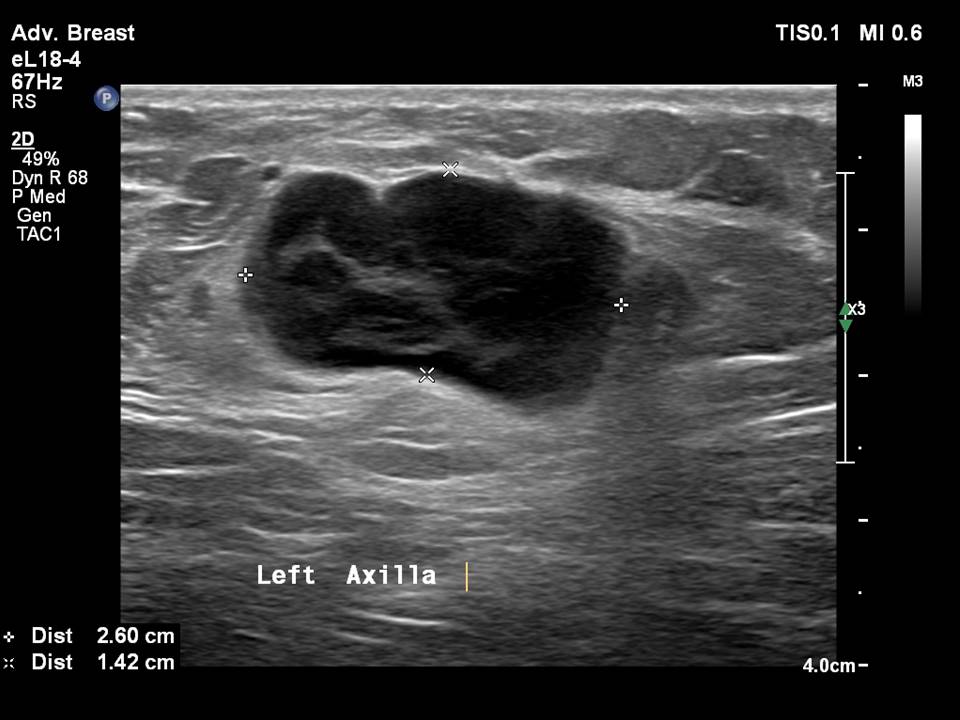 Atlas Of Breast Cancer Early Detection
