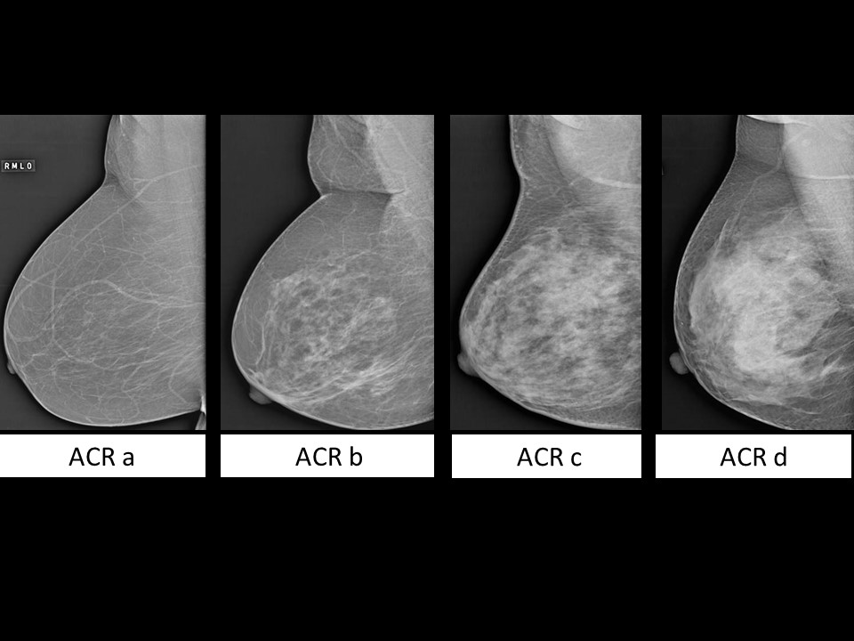 Normal breast MRI - dense breasts, Radiology Case