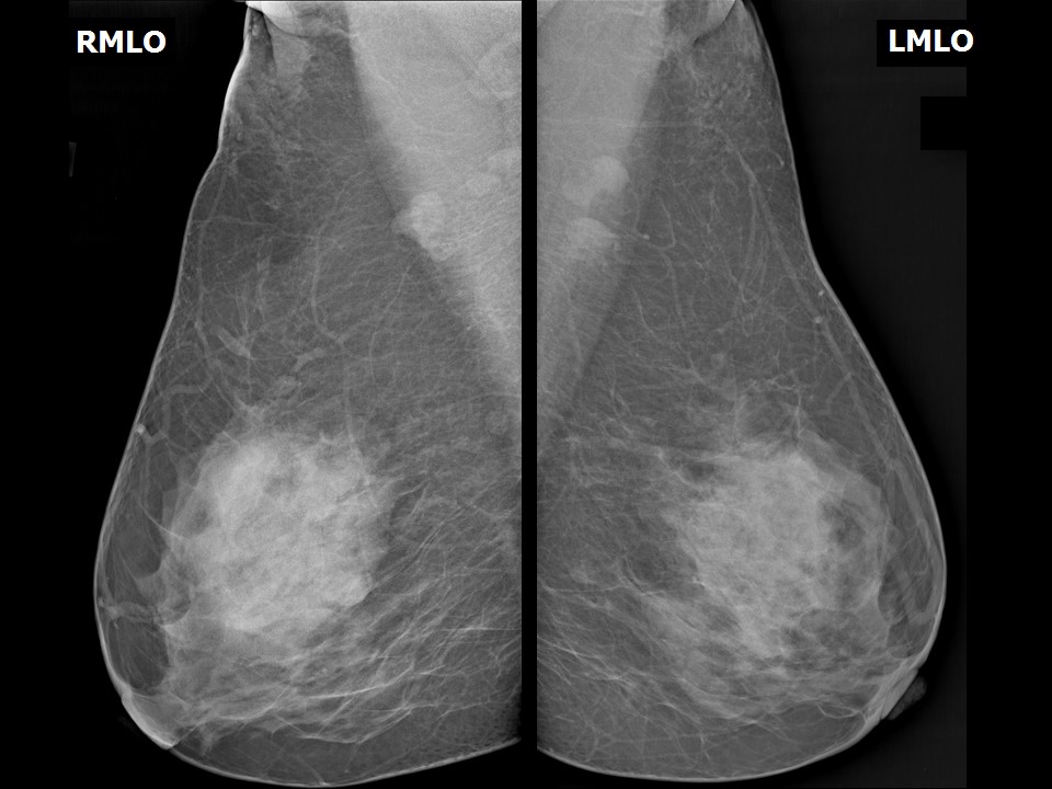 Normal breast - composition B, Radiology Case