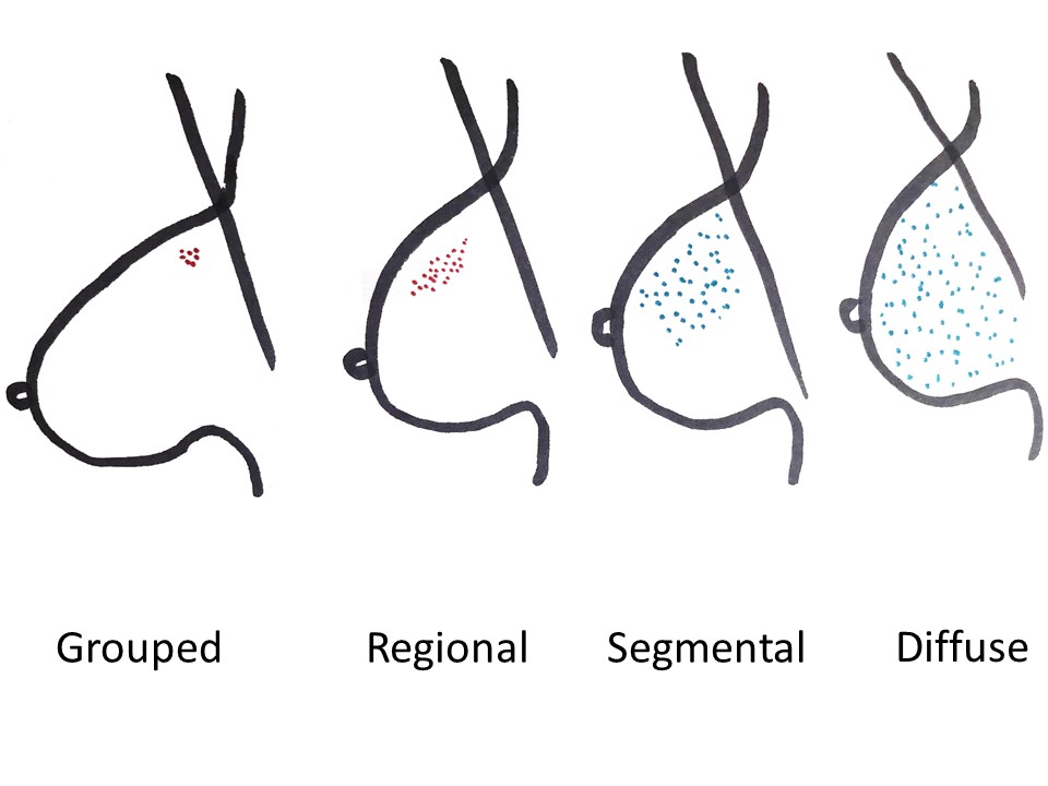 Wire movement distribution in various breast size. Breast is