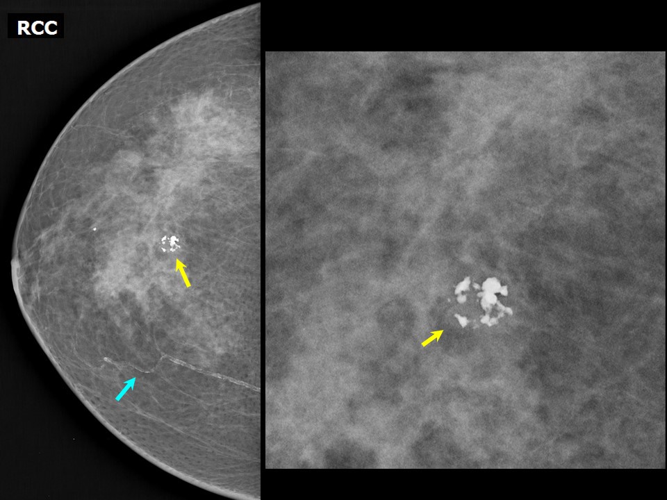 Calcification and mass abnormalities in breast mammogram scans