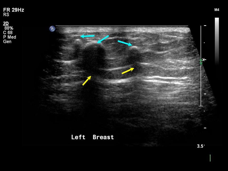 Atlas Of Breast Cancer Early Detection