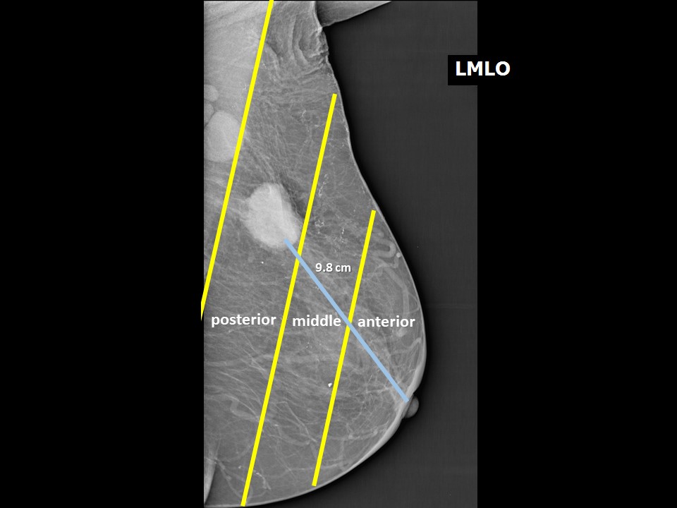 Atlas Of Breast Cancer Early Detection
