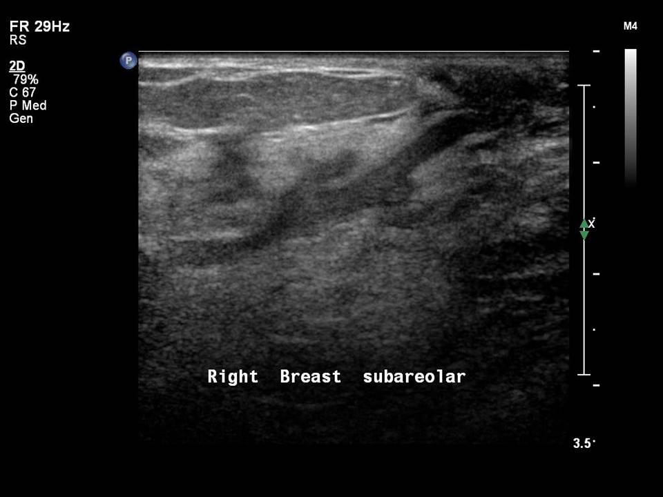 Atlas of breast cancer early detection