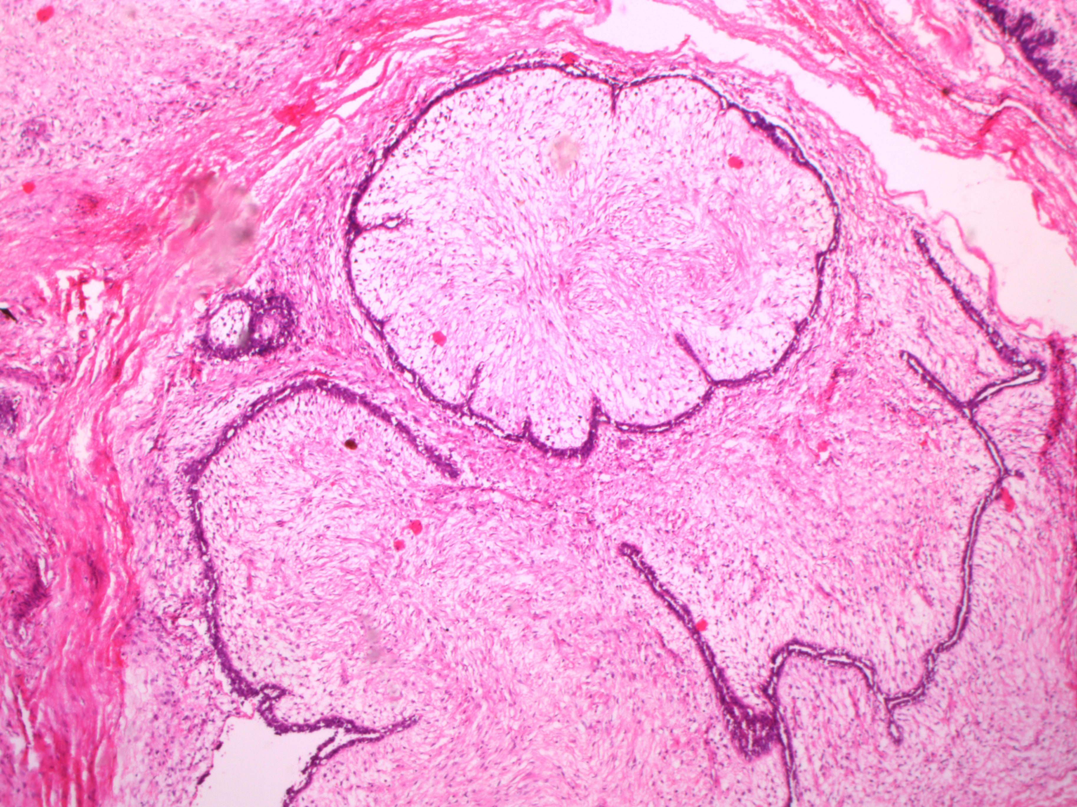 fibroadenoma