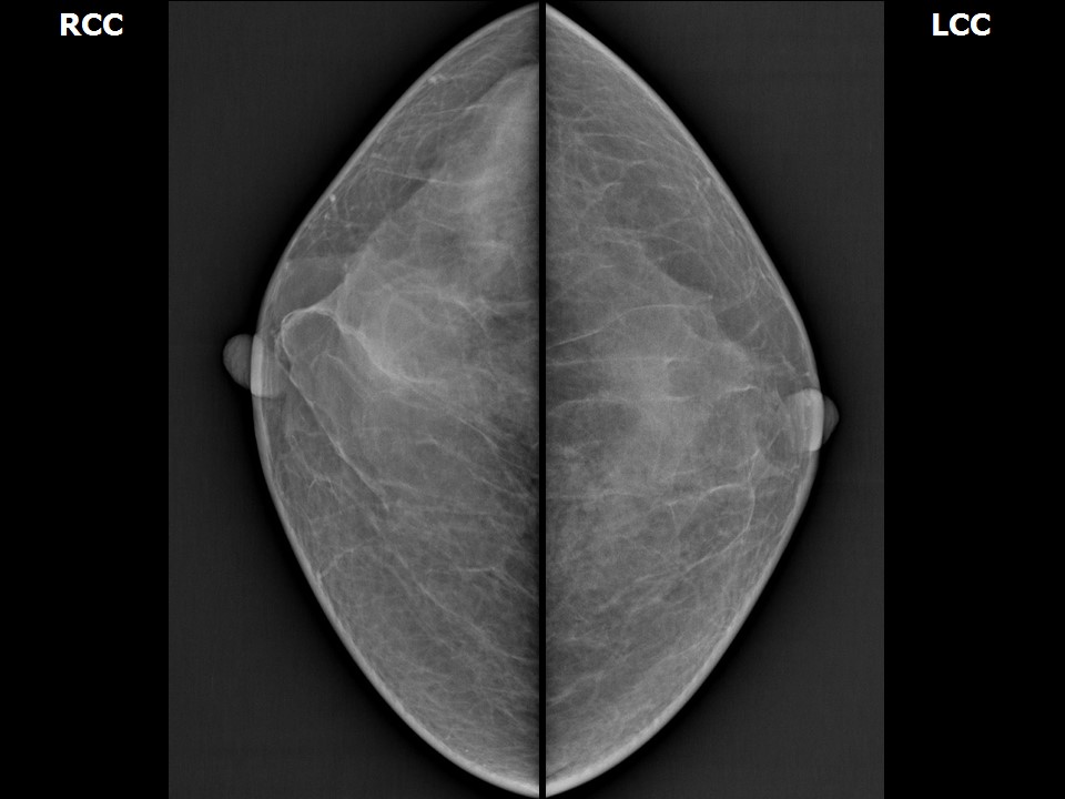 Atlas of breast cancer early detection