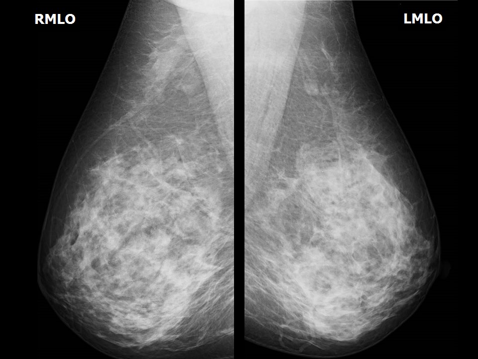 Atlas Of Breast Cancer Early Detection