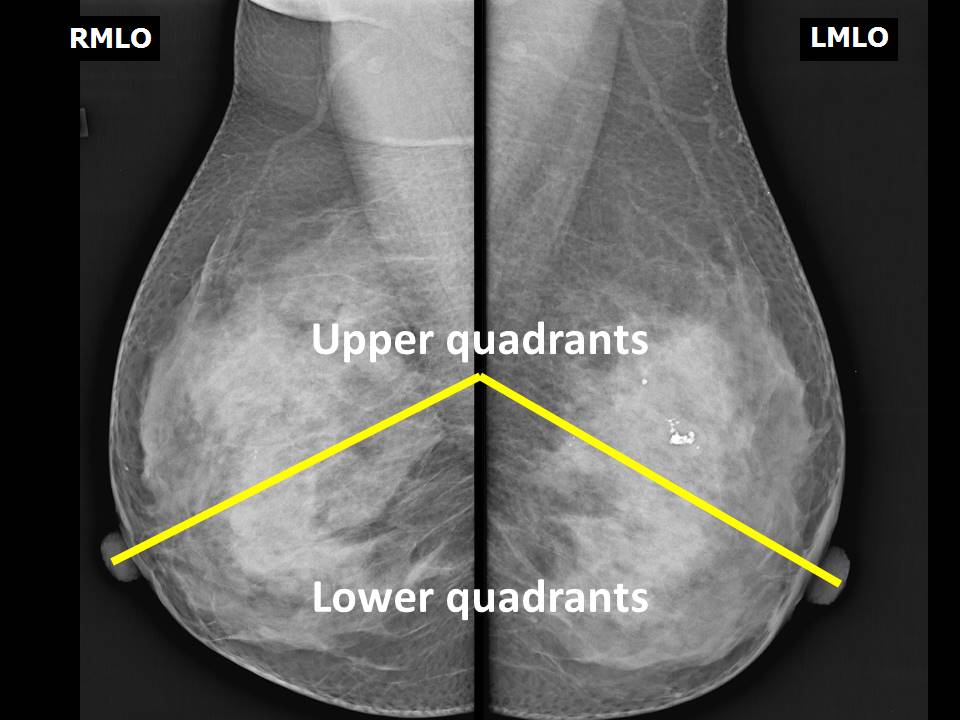 Breast cancer Quadrant Woman Mammography, breast-feeding, angle