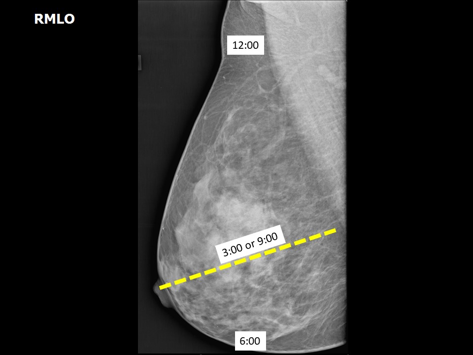 Mammography in Breast Cancer: Background, X-ray Mammography, Ultrasound