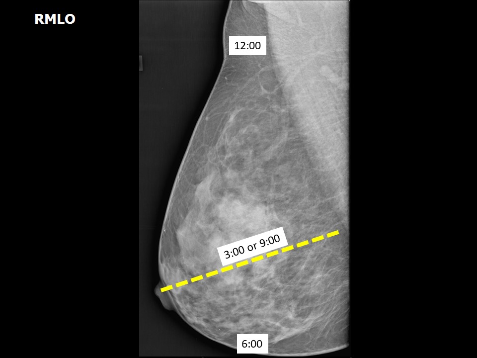 Atlas Of Breast Cancer Early Detection
