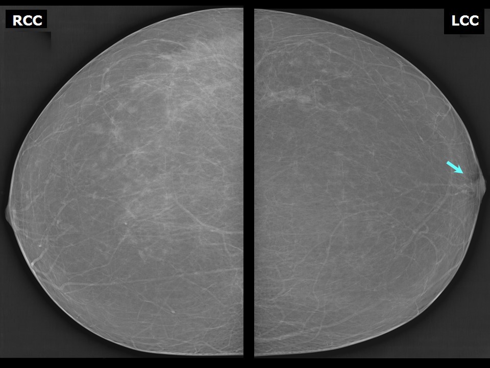 Diagnosis of Breast without Compression