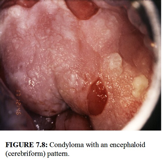 condyloma ectopia